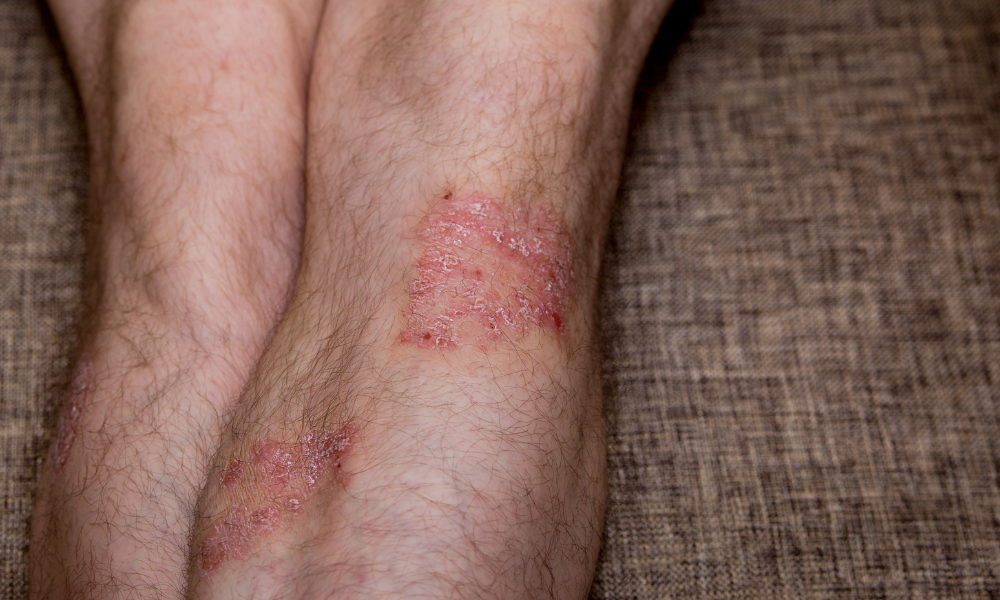 psoriasis on legs only
